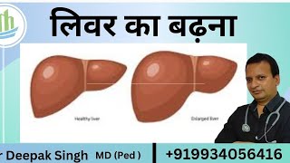 लीवर का बढ़ना लीवर का आकार बड़ा हो जाना Hepatomegaly medical doctor education [upl. by Ronica547]