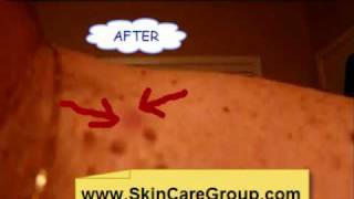 How To Remove Skin TagsWarts and Moles From Home [upl. by Glory]