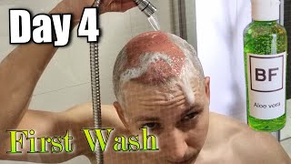 Day 4 after FUEDHI Hair Transplant First Full Head Wash [upl. by Ennairej]