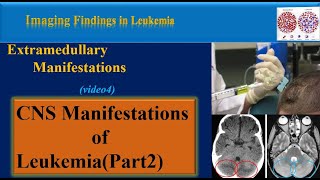 Leukemia Symptoms and Imaging Findings Video 4  CNS manifestations of Leukemia part2 [upl. by Aryamo477]