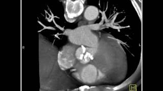 4D Imaging of the Aortic Valve Aortic valve 3 of 3 [upl. by Samalla]