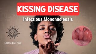 KISSING DISEASE or Infectious Mononucleosis [upl. by Eoz]