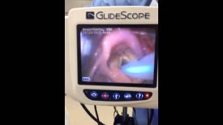 Glidescope intubation of neonate w failed NICU attempt due [upl. by Salkcin]