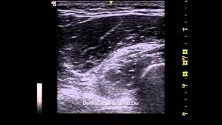 Supinator syndrome  Sonoguided PIN injection [upl. by Meares410]