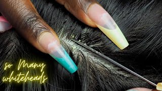 ASMR ATTENTIVE Scalp NITPICKING so many 😴 WHITEHEADS  super zoomed [upl. by Aivatan69]