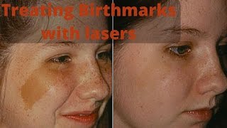 How to treat birthmarks [upl. by Ziegler]