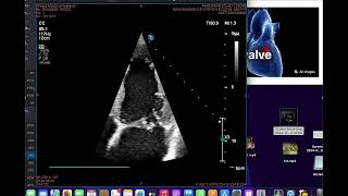 Flail anterior mitral leaflet [upl. by Talya]