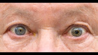 Anisocoria  Symptoms and Causes  Diagnosis  Treatment  Prevention [upl. by Notreve]