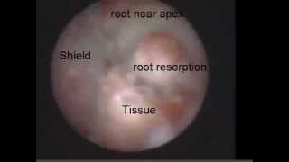 External Root Resorption 2 Viewed with the Perioscope [upl. by Oicaroh]