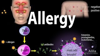 Allergy  Mechanism Symptoms Risk factors Diagnosis Treatment and Prevention Animation [upl. by Esylla]