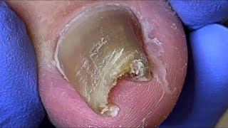 Amazing Curly and growing onychomycosis professional pedicure【Doctor Liu Pedicure】 [upl. by Gnilsia]