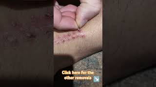 Suture Self removal after 2 weeks video no4 weird health healing [upl. by Eloken534]