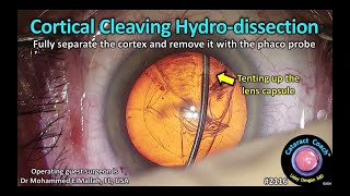 CataractCoach™ 2116 cortical cleaving hydrodissection [upl. by Gratia]