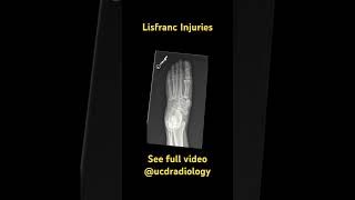 Lisfranc injuries radiologist anatomy radiology radiologyresident medicine orthopedics [upl. by Darcy505]