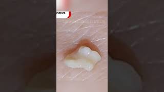 Huge Tonsil Stone [upl. by Ail785]