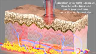 Laser pigmentaire Traitement taches brunes solaires mélasma Dr Loubeyres Pau [upl. by Adelaide]