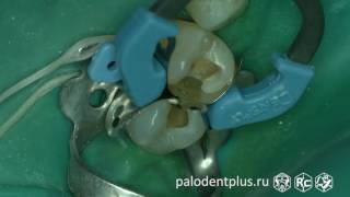 Rubberdam case 072 II Class Palodent Plus 4K [upl. by Aihseuqal]