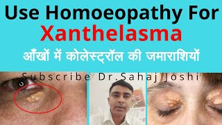 Xanthelasma Homeopathic medicine for Xanthelasma [upl. by Ajile271]