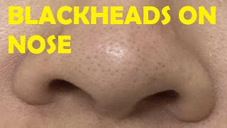 05 Best Nose Plucking Blackheads Whiteheads Removal  Acne Treatment [upl. by Pet]