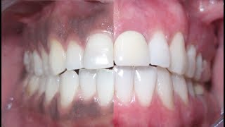 Remove dark gums with WATER [upl. by Edward280]