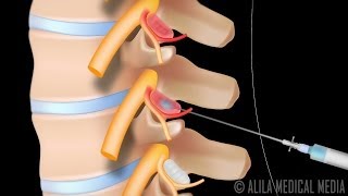 Lumbar Facet Joint Injection Procedure Animation [upl. by Retsehc]