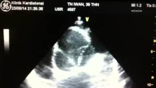 NonCoaptation Aortic Valve with Aortic Root Dilatation [upl. by Klotz]