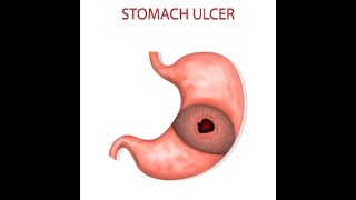 Signs and Symptoms of Gastric Ulcers [upl. by Morris]