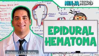 Epidural Hematoma  Anatomy Etiology Pathophysiology Clinical Features Treatment [upl. by Behn991]