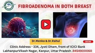 Treatment of Fibroadenoma in Both Breasts breast breastcancer drrahulbabaji drmenka8055 [upl. by Dewayne]