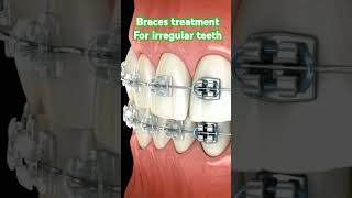 Metal and ceramic braces orthodontics braces irregular teeth dental healthyteeth trending [upl. by Antons]