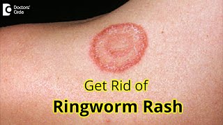 7 GREAT Tips for Prevention amp Treatment of RINGWORM RASH Dr Amrita Hongal Gejje  Doctors Circle [upl. by Lianne]