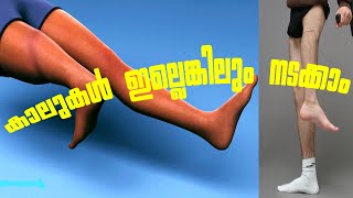 ROTATIONPLASTY SURGERY MALAYALAM ANIMATION [upl. by Inga]