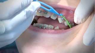 How to Wear Orthodontic Elastic Bands [upl. by Lramaj]