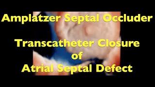 Amplatzer Septal Occluder Large Atrial Septal Defect [upl. by Anerat]