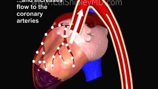 Cardiogenic Shock and Intraaortic Balloon Pump by Dr Cal Shipley MD [upl. by Matuag]