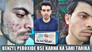 Acne Transformation With Benzyl Peroxide 25  Benzyl Peroxide Soap Use Karna Ka Sahi Way [upl. by Feldstein]