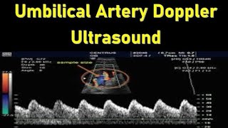 Umbilical Artery Doppler Ultrasound Interpretation  Doppler Ultrasound in Fetal Growth Assessment [upl. by Arhna]