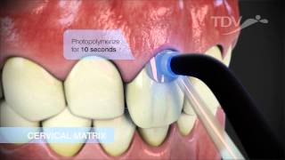 CERVICAL MATRIX TDV  Class V Restorations [upl. by Cupo]