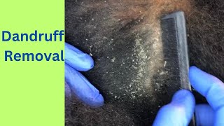 Dandruff Removal  Large flakes  good scratch [upl. by Moulden]