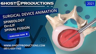 Medical Animation Spineology OptiLIF Spinal Fusion  Ghost Productions [upl. by Iraam416]