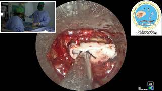 Rt L5S1 endo discectomy [upl. by Florine]