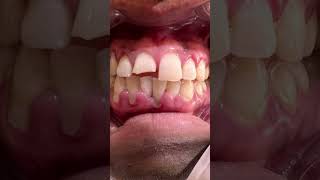 Dental talk 29Root caries rootcaries rootcanalspecialist rootcanals oralcare [upl. by Claud]