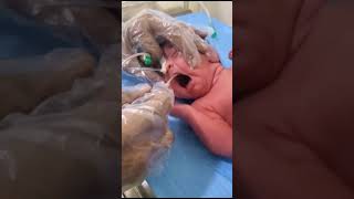 Suction process of newborn for nose and mouth clean bad water [upl. by Seth]