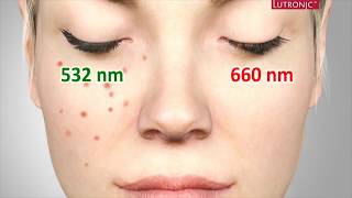 Freckles Pigmentation Treatment Singapore Ruvy Touch Pico Laser  Dr Justin Boey [upl. by Marmawke]