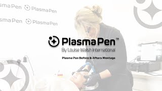 Plasma Pen Before and After  Fibroblast Before and After Treatment  Plasma Pen [upl. by Yelwah]