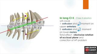 Long and short Class II elastics [upl. by Aivata]