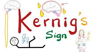 Kernig Sign  Meningitis  Neurology Physical Exam [upl. by Vitia]