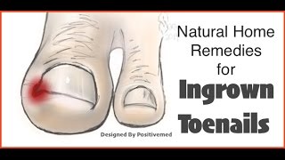 Natural Home Remedies for Ingrown Toenails [upl. by Trix]