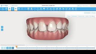 Invisalign Deep Bite and Diastema Correction How I engineer tooth movement Nirenblatt Orthodontics [upl. by Laise427]