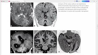 NEURO IMAGING EISENBERG [upl. by Phelps333]